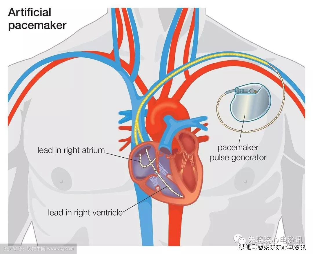 心脏起搏器的原理_心脏起搏器脉冲产生原理是什么,说清楚点好吗