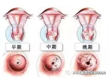 如果癌组织坏死,感染,会排出较多混有血液的恶臭白带;宫颈癌晚期症状