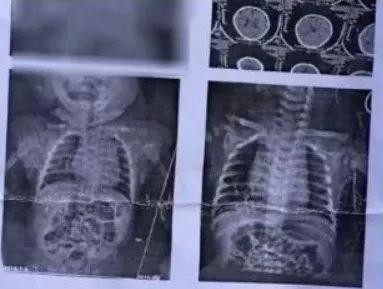 婴儿车■3个月宝宝摔成脑震荡,婴儿车这么用,就是不顾孩子死活!忽略一件事