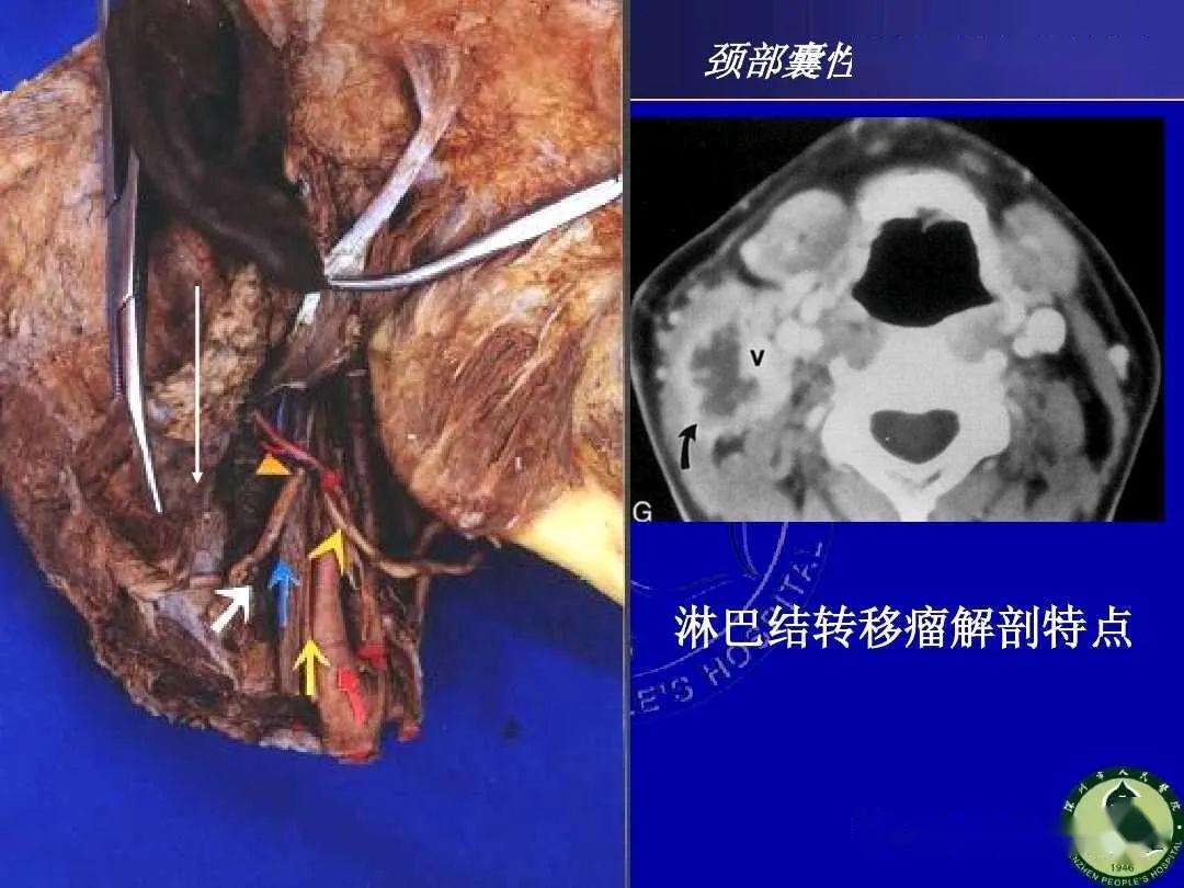 颈部囊性肿块的影像学诊断