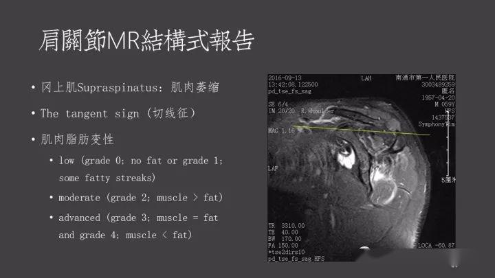 肩关节mri报告如何规范书写