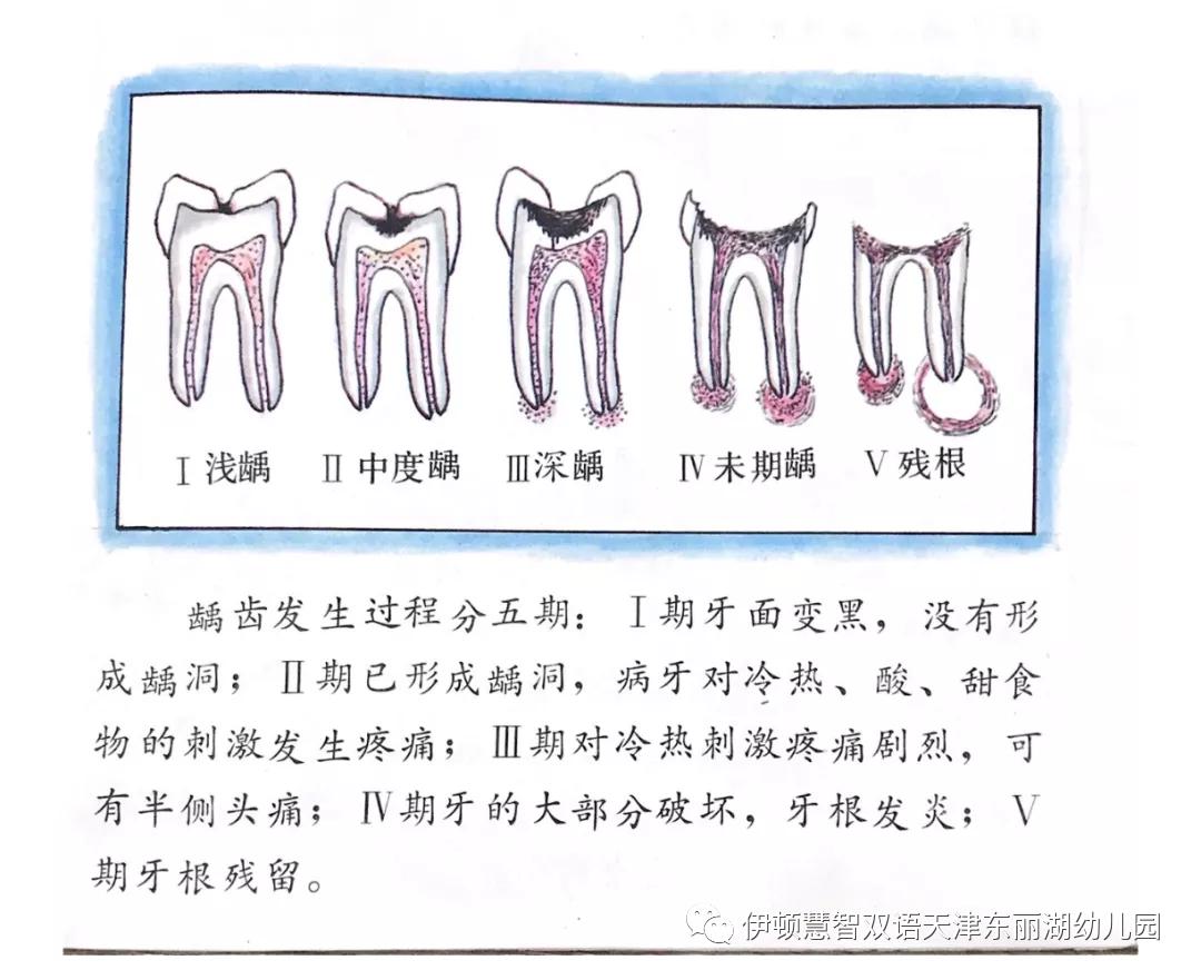 专家解读3:龋齿治疗