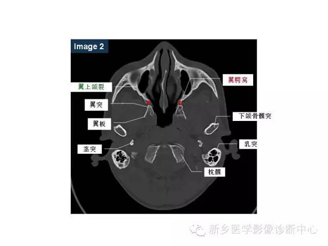 鼻咽部的详细解剖含各个孔道