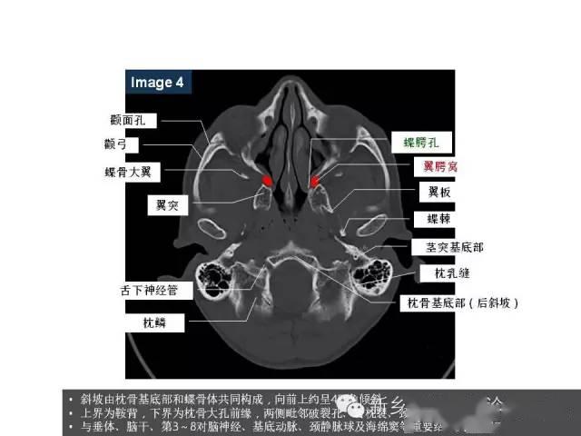 鼻咽部的详细解剖含各个孔道