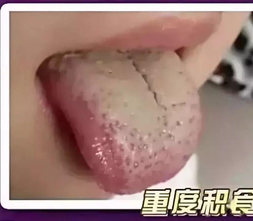 『发出的』宝宝发出的积食信号你能看懂多少?过度喂养危害大