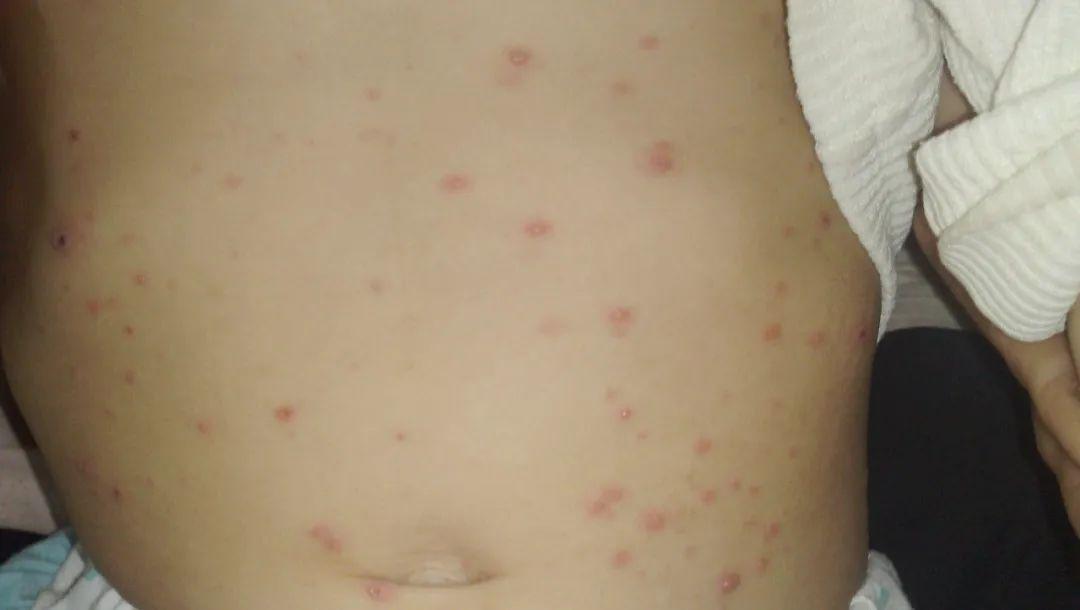 三,水痘 有水痘接触史,发热当天出现高出皮面的红色疹子,一天后就