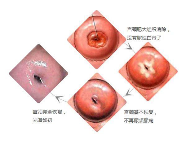 宫颈肥大,到底多大才算「肥大」呢?