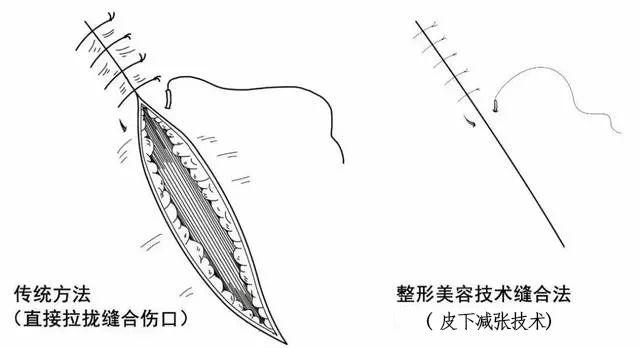 如何让受伤的孩子少留疤?建议选择"美容缝合"