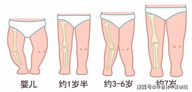 2岁后,一旦孩子的膝内翻得到纠正,双下肢的发育又会向膝外翻发展,在3