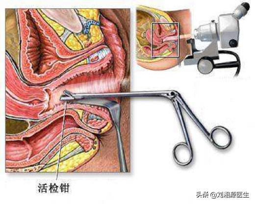 引产后有炎症怎么办