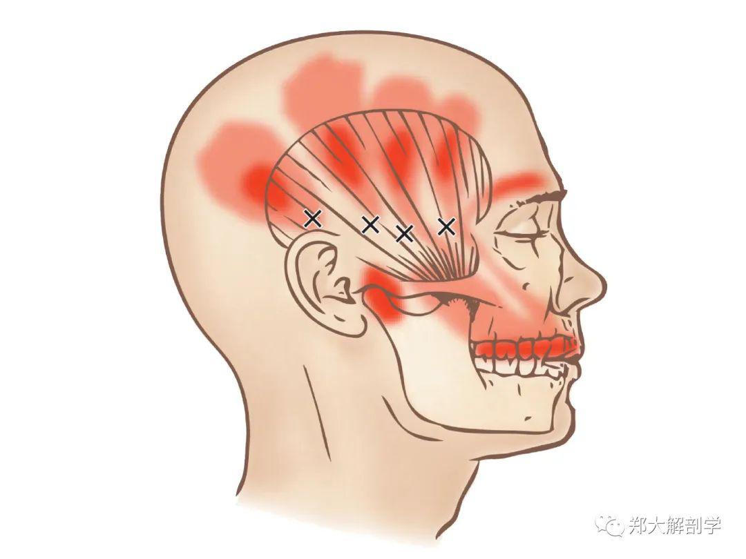 颞肌的扳机点会导致头部前面和侧面的疼痛.2.