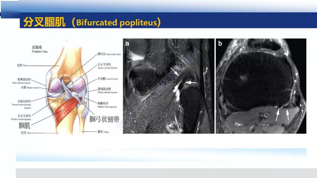 温故知新图文详解膝关节解剖变异影像诊断5类18种