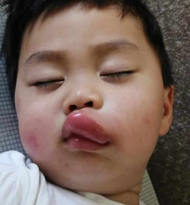 『蚊虫』一觉醒来儿子模样大变,妈妈既心疼又想笑儿子嘴巴被蚊子“亲”了一口