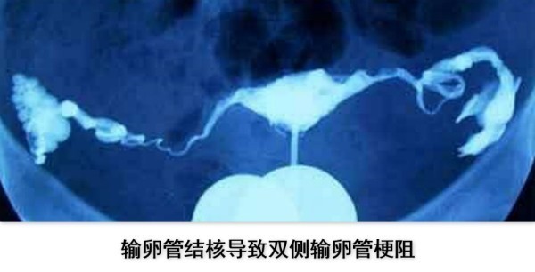 结核病离我们并不遥远,育龄妇女请多关注!