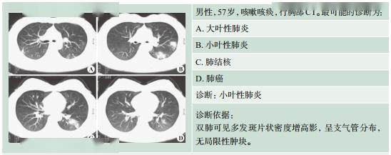 记忆:大叶性肺炎 =青年人   发热   大片白斑片影.