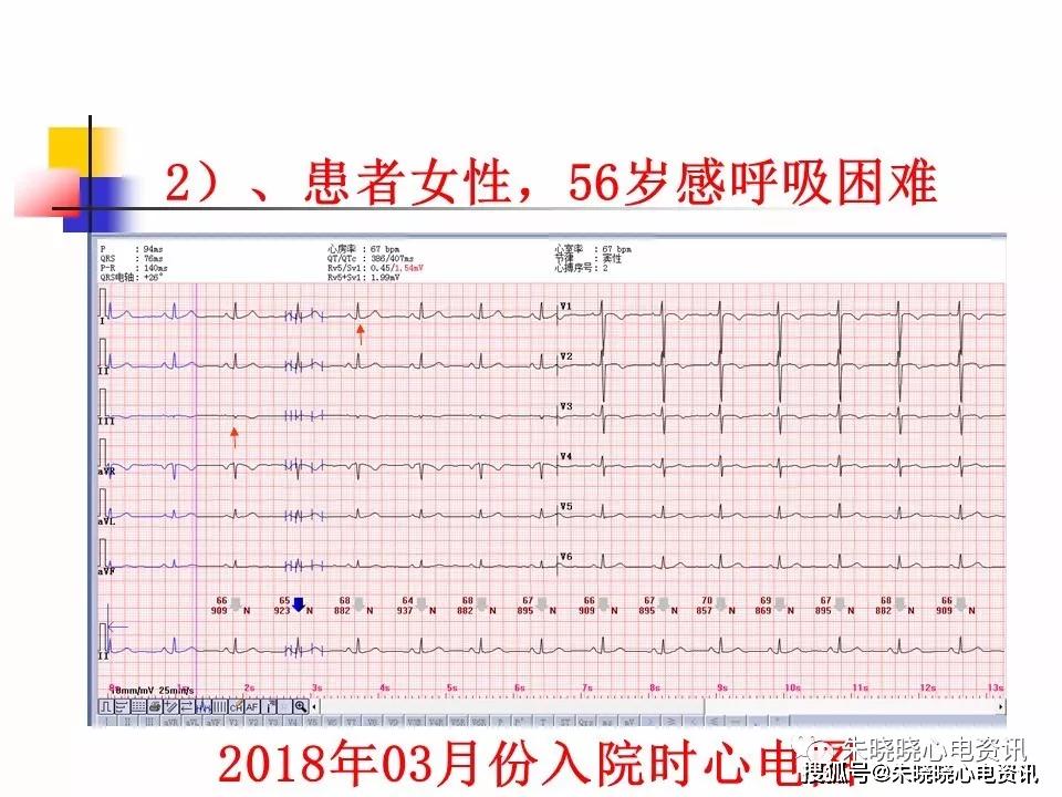 谢相屹老师:常见的心电图危急值识别(ppt)