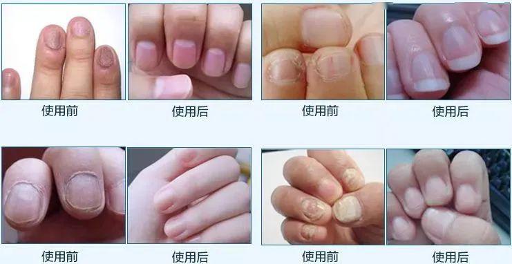 灰指甲就用它,15天重获亮甲,摆脱10年灰指甲!
