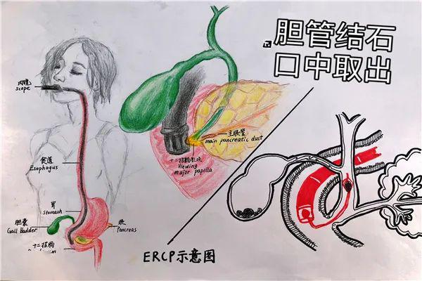 胆管结石 口中取出 潍医附院肝胆胰外科有绝招!