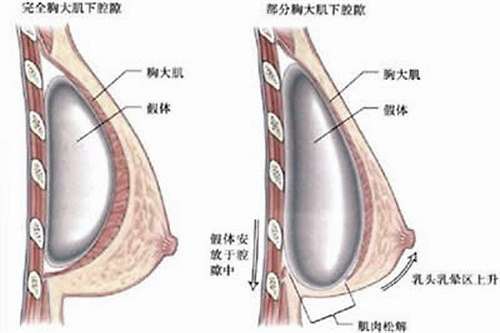 最软的假体_想做假体隆胸 先看看业界大咖们怎么说