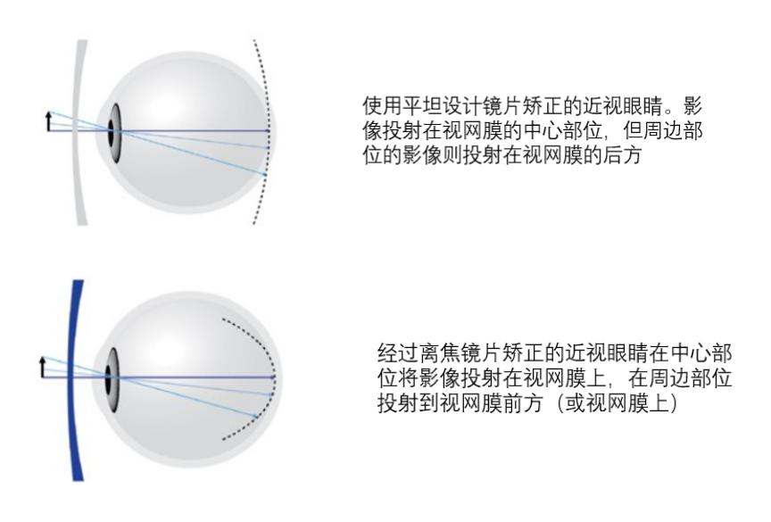 环焦镜片的原理_黄炳南 环焦镜片的定配原则与注意事项