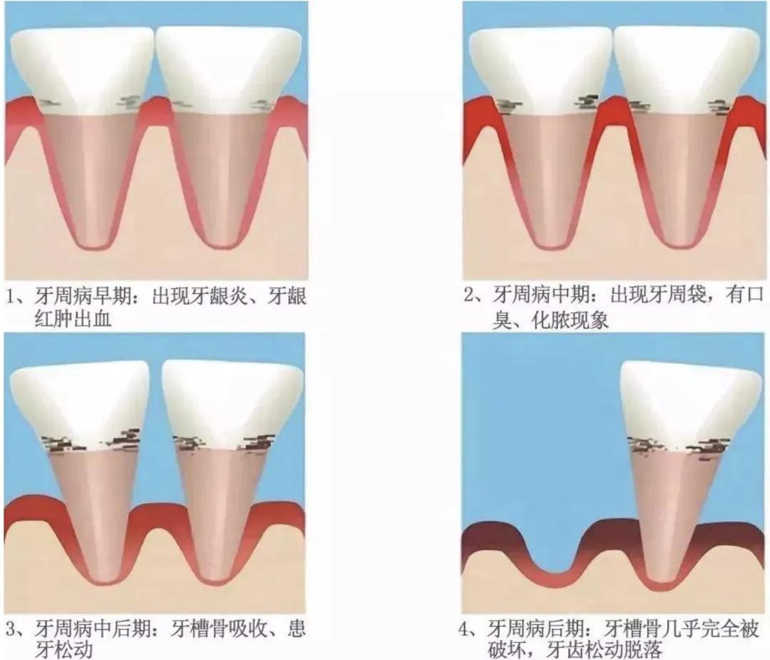 牙周炎的疼痛特点