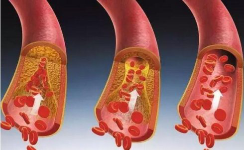 动态心电图能检查出心梗吗 81a2b0268be24151a49221db9d1f06a5.png