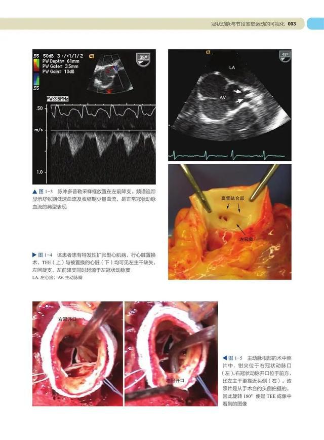 学习tee必备 | 术中及介入超声心动图:经食管影像图谱