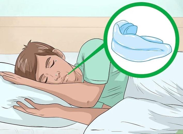 塑料的牙箍,也叫作前庭盾,睡前放在口中,能帮你用鼻子而不是用嘴呼吸.