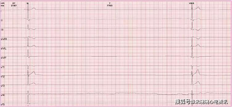 图1. 心电图示窦性心律,心室停搏7.7秒.
