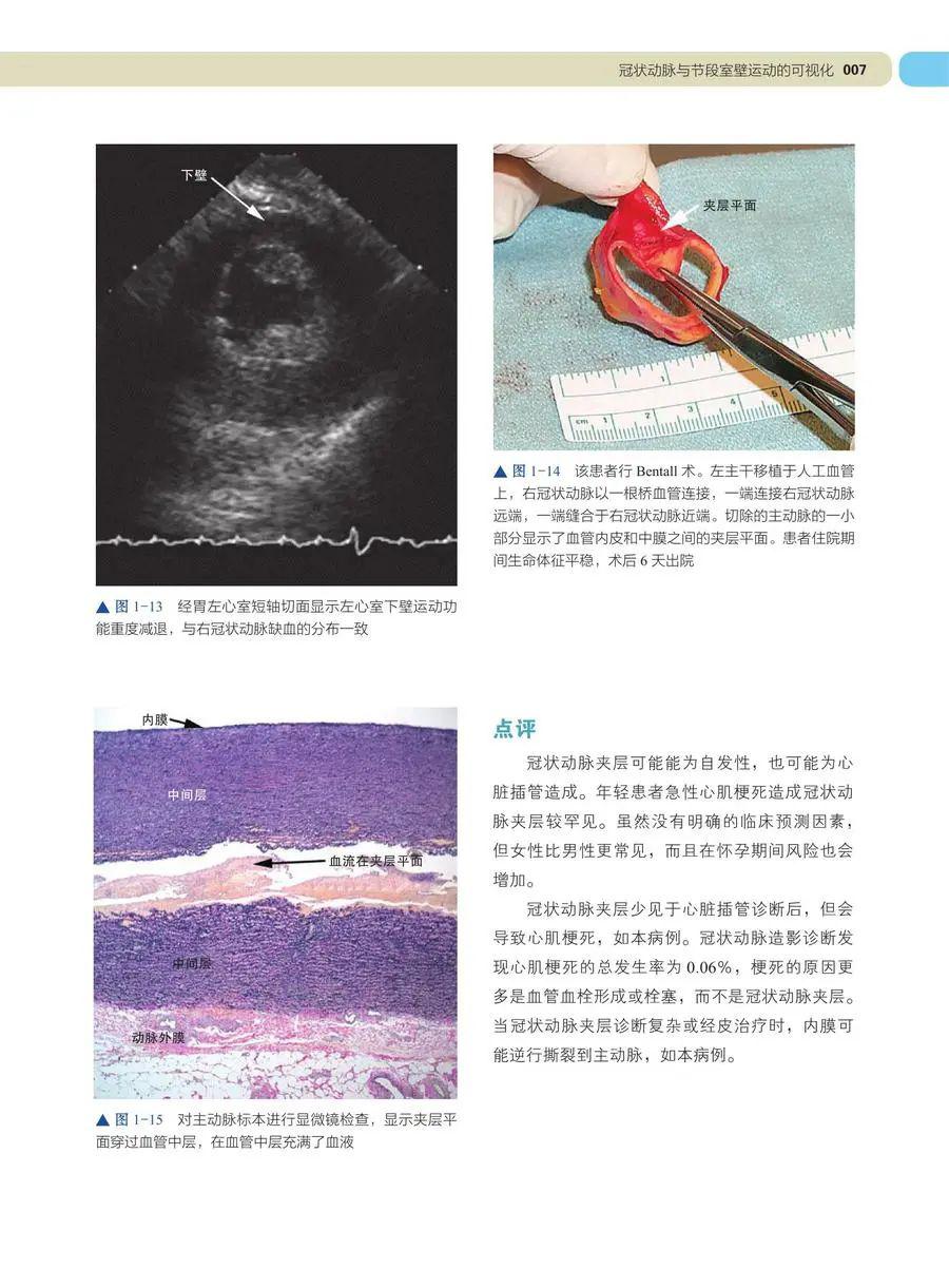 学习tee必备 | 术中及介入超声心动图:经食管影像图谱