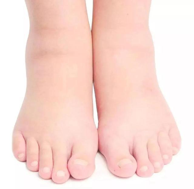 「杏林微科普」下肢肿胀如象腿，原因为何？