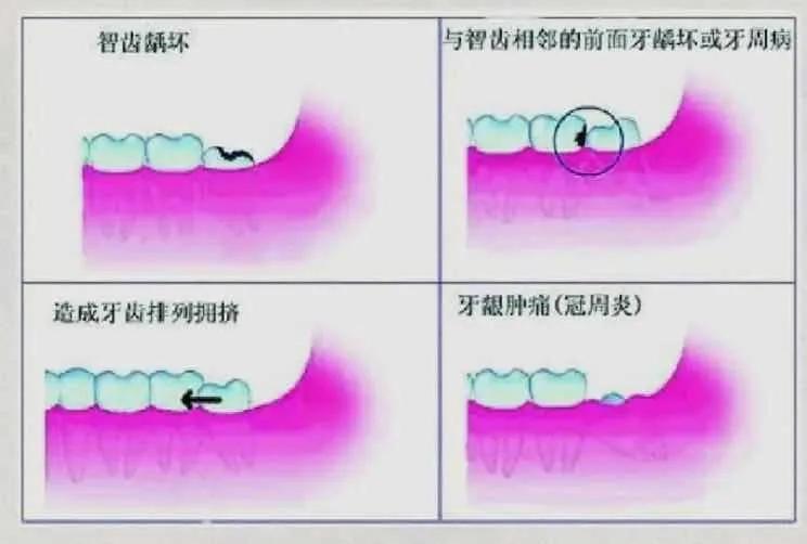 智齿冠周炎的疼痛特点no.