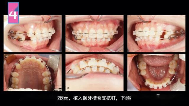 89期露龈笑骨性凸矫正女汉子牙医的变美经历