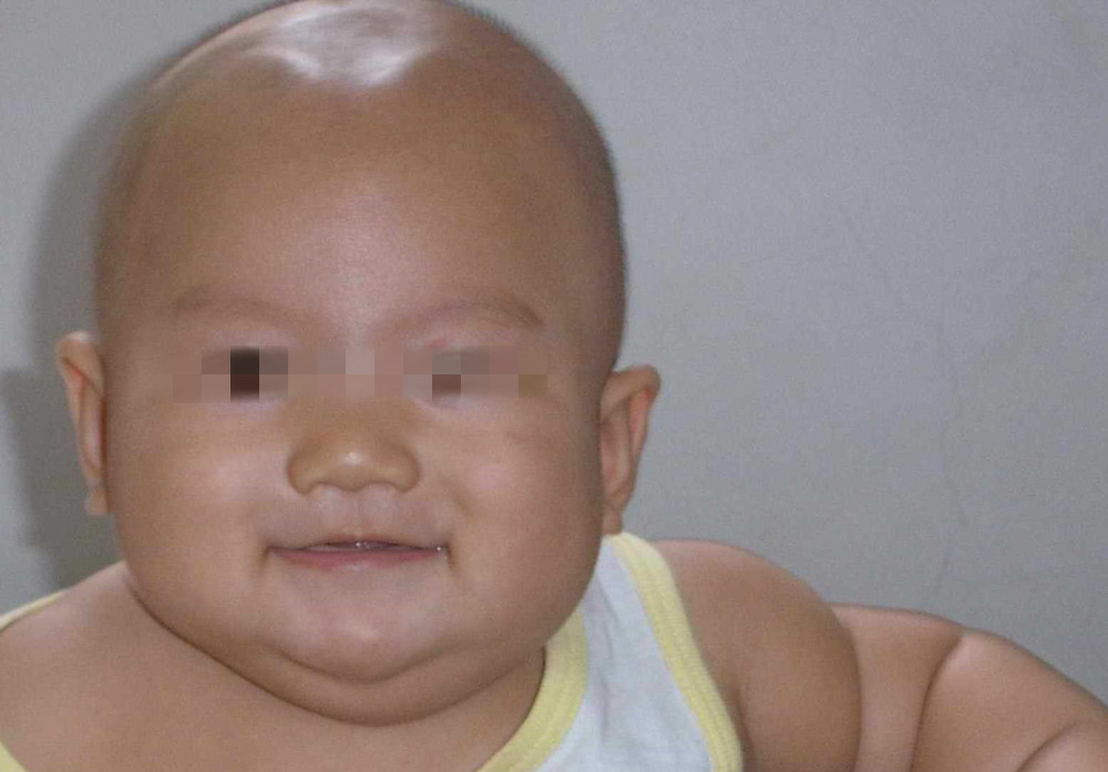 「囟门」孩子不聪明？别急，父母需同时参考下头围宝宝囟门闭合太早
