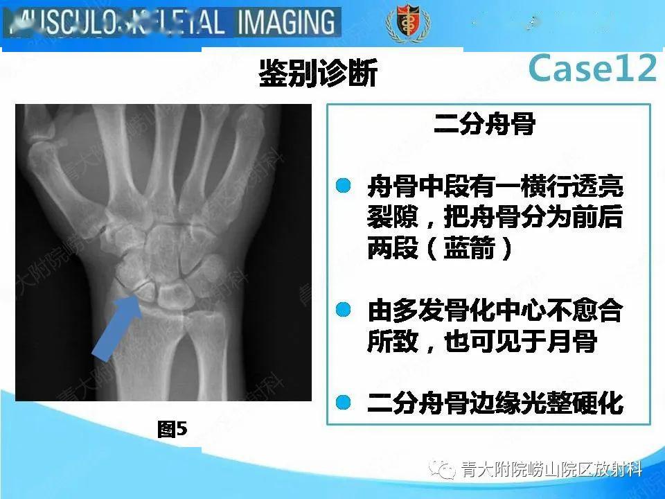 一问一答:舟骨骨折