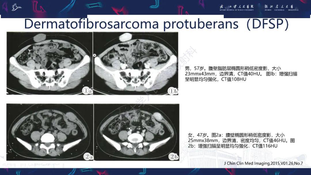 腹壁骨外尤文肉瘤影像诊断