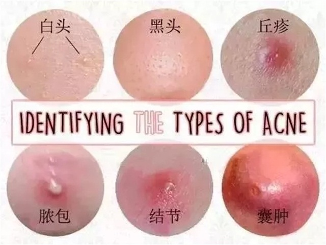 祛痘药膏用着用着就变激素脸了安全接地气的8支祛痘药膏都在这了