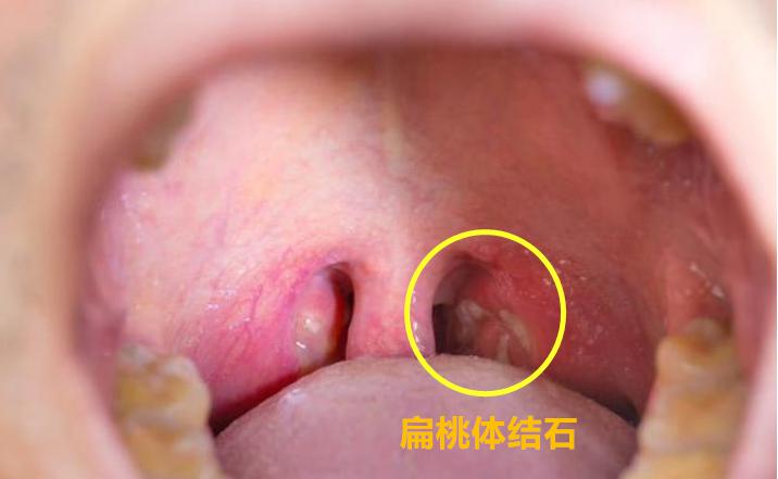 孩子喉咙掏出的小石头,竟是口臭的罪魁祸首,赶紧拿镜子照照!