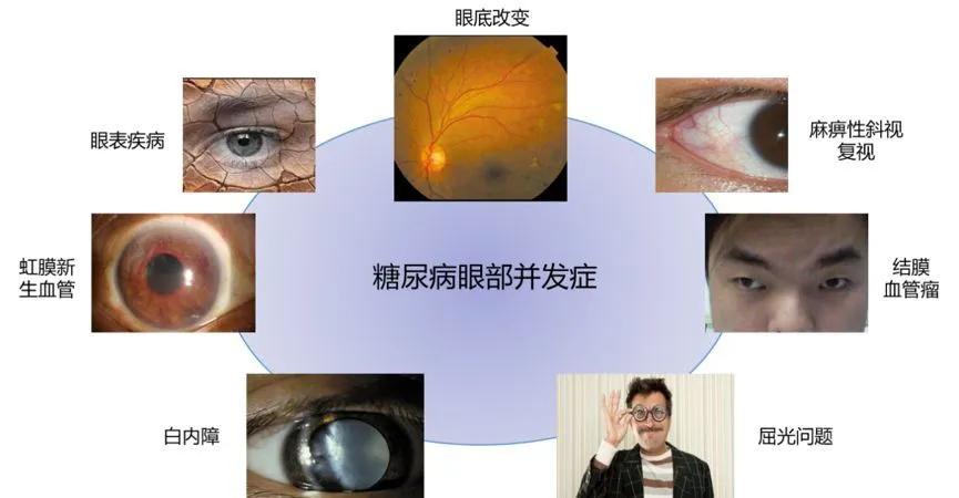 病变虹膜红变糖尿病性白内障糖尿病的眼部并发症可以有很多不同的表现