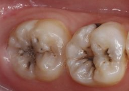 牙齿出现了或深或浅的龋坏,从外面看就表现为一个黑点,通常位于窝沟