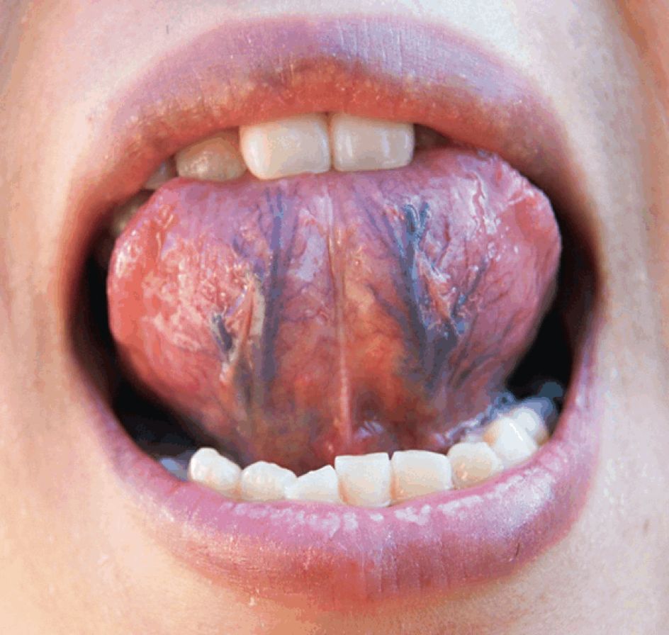 血瘀体质的人舌象是什么样子?