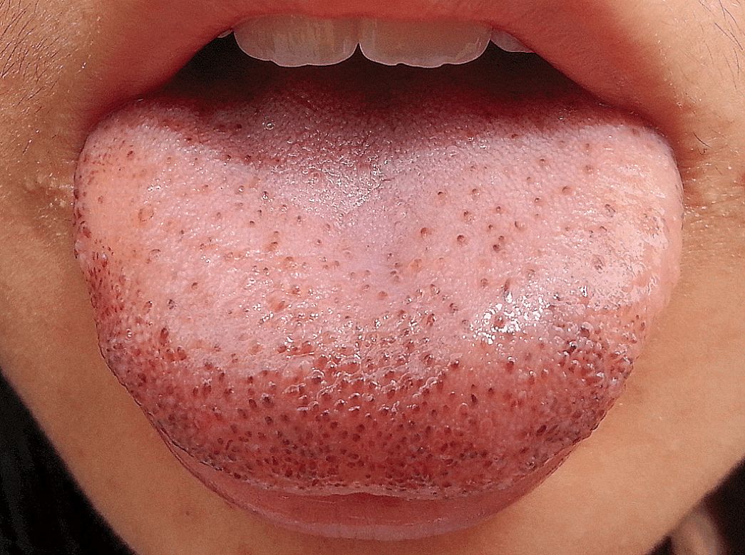 如果舌头里的毛细血管堵了,血液就会由红变成黑色,黑点就是蕈状乳头
