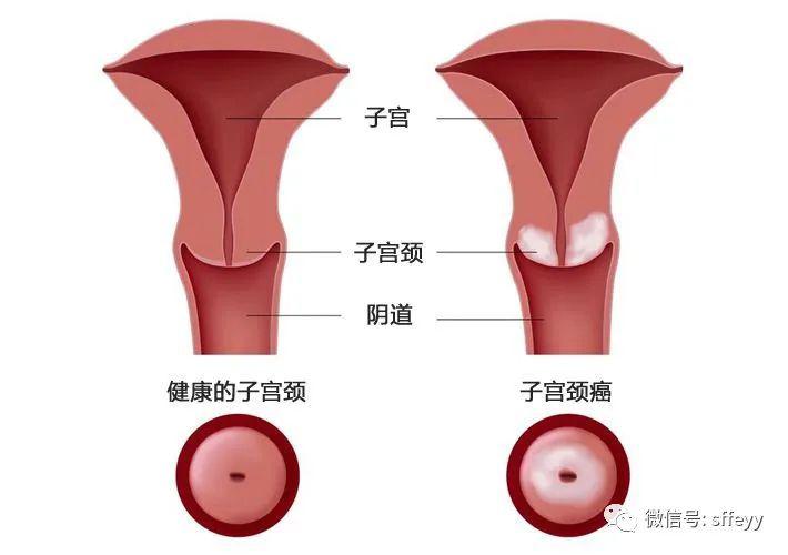 宫颈炎跟宫颈糜烂的区别