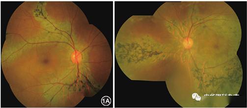 【图片精粹】色素性静脉旁视网膜脉络膜萎缩
