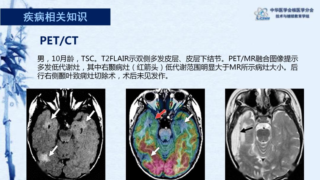 【病例】75期:范岩 结节性硬化18f-fdg pet/ct脑显像