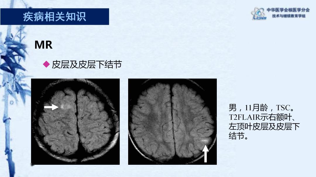 【病例】75期:范岩 | 结节性硬化18f-fdg pet/ct脑显像