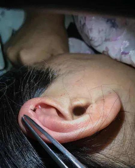 一位患者耳朵被蜱虫死死咬住