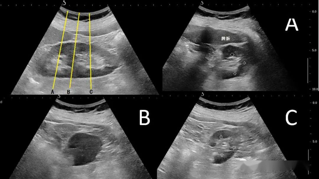 箭头所示为肾窦.图3 无脸肾声像图(a)右肾超声图像显示肾窦正常.