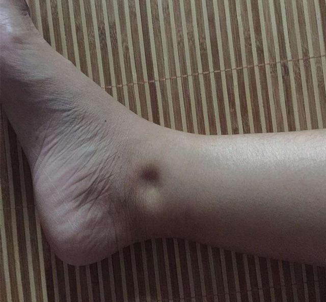 没有任何征兆,但随着病情日益严重,就可能出现一系列的症状,包括水肿