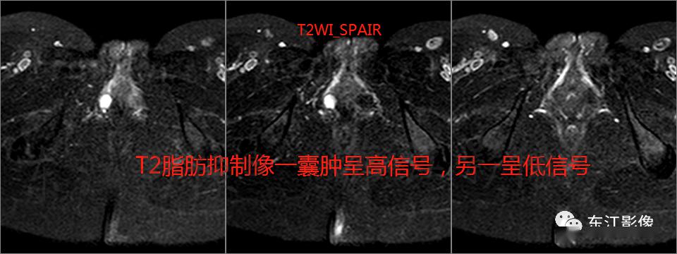 谢纳管囊肿(skene duct cyst)又称尿道旁腺囊肿.